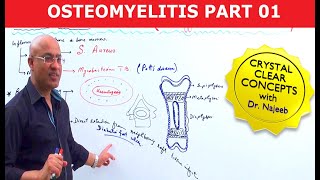 Acute Osteomyelitis  Orthopedics for Medical Students [upl. by Lianna672]