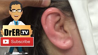 How to use Phonak ear moulds [upl. by Arracahs]