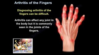 Arthritis Of The Fingers  Everything You Need To Know  Dr Nabil Ebraheim [upl. by Reckford]