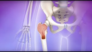 Understanding Myelodysplastic Syndromes MDS [upl. by Astrid]