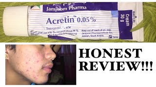 acretin 005 honest review [upl. by Dugan]