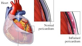 Pericarditis [upl. by Satsoc]