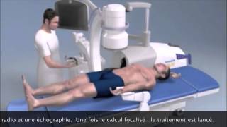 Lithotripsie extra corporelle  Extracorporeal Shock Wave Lithotripsy Montpellier [upl. by Three263]