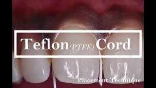 Teflon PTFE cord Placement technique [upl. by Llet944]