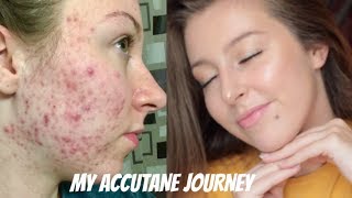 MY ISOTRETINOIN ACCUTANE JOURNEY  BEFORE AND AFTER PHOTOS [upl. by Akirahc999]