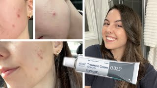 HOW I CLEARED MY SKIN IN 1 MONTH  Tretinoin Cream 0025 Before and After [upl. by Alleiram]