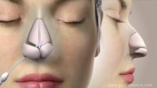 Rhinoplasty Nose Job Video Animation  Guncel Ozturk MD  DRGO [upl. by Flessel879]