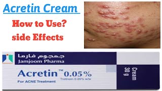 Acretin Cream  How to Use  Tretinoin  Acne Treatment [upl. by Arinaj409]