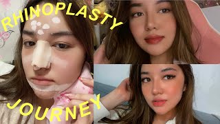 MY RHINOPLASTY JOURNEY 2 WEEKS POSTOP  Andrea Angeles [upl. by Azne]