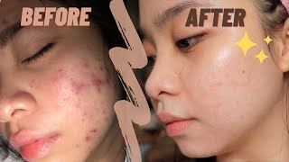 The best ANTI ACNE CREAM ✨  my holy grail  TRETINOIN [upl. by Aihtak408]