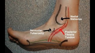 How to Diagnose Tendonitis vs Patellofemoral Understanding KNEE PAIN [upl. by Amati865]