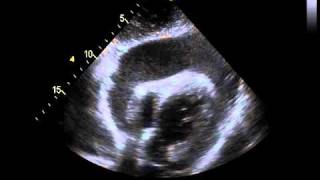 Constrictive pericarditis Etiology and presentation [upl. by Suanne]