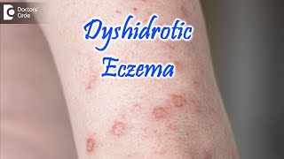 Dyshidrotic Eczema  POMPHOLYX   Causes Symptoms amp Treatment  Dr Nischal K  Doctors Circle [upl. by Pulchia140]