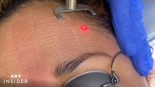 Minimize Acne Scarring With Laser Resurfacing [upl. by Isaak]