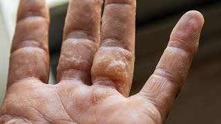 Dyshidrotic Eczema What Is Dyshidrotic Eczema [upl. by Epifano]