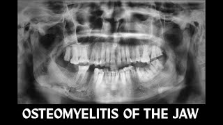 OSTEOMYELITIS ACUTE amp CHRONIC SUPPURATIVE [upl. by Ahtibat]